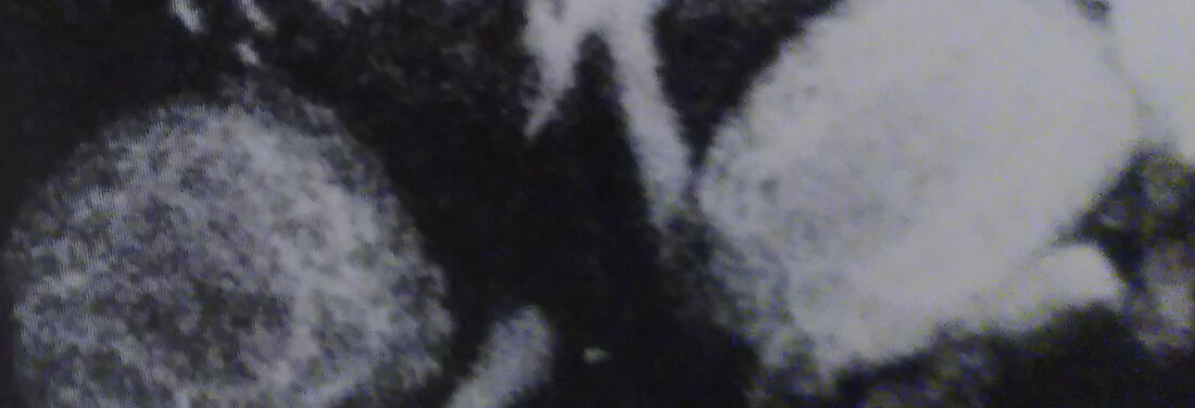 Black-and-white image showing two round, high-contrast shapes on a dark background.