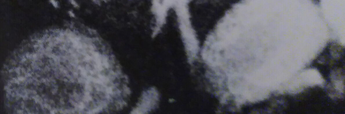 Black-and-white image showing two round, high-contrast shapes on a dark background.