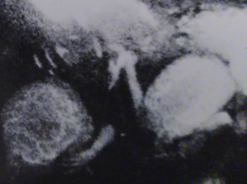 Cropped black-and-white image showing two adjacent round shapes.